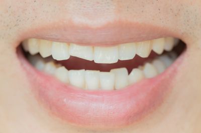 An Emergency Dentist May Save Damaged Teeth!