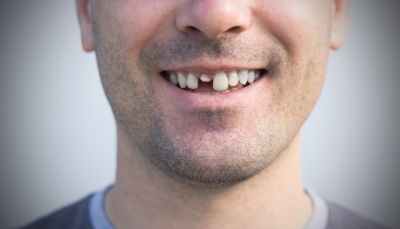 An Endodontist Can Provide Treatment for Dental Trauma Cases!