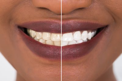 Get an Enhanced Aesthetic Appeal with Teeth Bleaching Service!