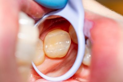 Prevent Further Decay of Your Tooth with Cavity Filling!