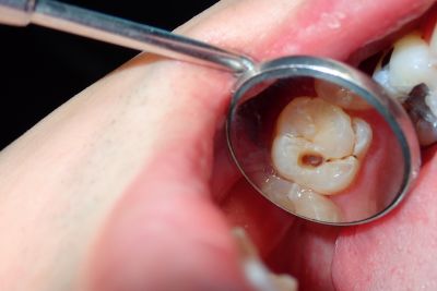 Prevent Further Decay with Dental Fillings!